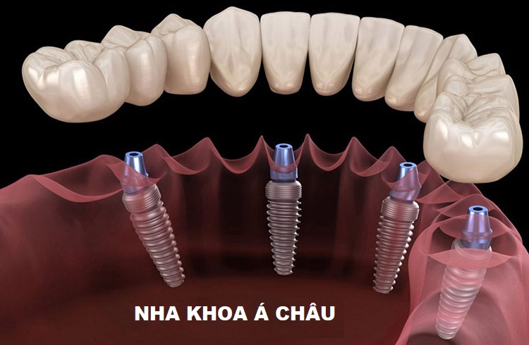 Cấu Tạo Trụ Implant? Cách chọn trụ Implant phù hợp ẢNH 2